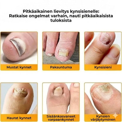 FungalPatch – Intensiivinen kynsienhoitosetti – Itseliimautuvat sienihoitolaastarit